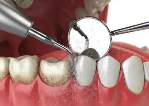 洗牙齿有什么好处和坏处，清洁牙齿/但可能造成牙龈出血